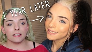 Facial Feminization Surgery - One Year Post-Op | Stef Sanjati