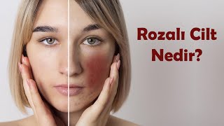 Rozalı cilt (Gül Hastalığı) nedir? Kızaran ve yanan ciltler için cilt bakımı