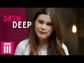 Owning My Looks Despite Facial Disfigurement | Katie | Skin Deep