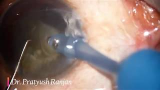 Topical Phaco in Posterior Subcapsular Cataract  (PSC)