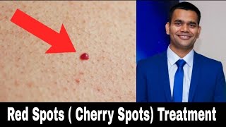 Red Skin Dots ( cherry Angioma ) Natural Treatment | Dr. Vivek Joshi