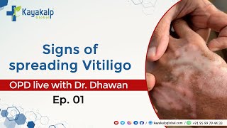 Signs of spreading Vitiligo | OPD with Dr. Dhawan |  @kayakalpglobal1 | 📞 9599794433 | Safed daag ka ilaaj