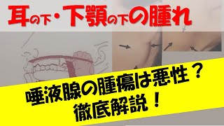 顔やあごの腫れ・腫瘍は「がん」ですか？～耳や顎の腫瘍（唾液腺腫瘍）について【現役耳鼻科医が解説！】