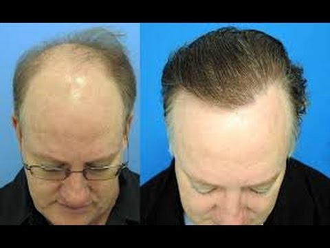 Natural Treatment For Bald Head ఇల చ స త వ ర