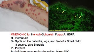 Henoch-Schonlein Purpura (HSP) [Mnemonic]