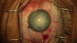 Surgery: Phacoemulsification in a Mature Liquefied Cataract: Dr. James Lehmann