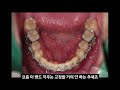 치아교정후 턱이 불편 턱위치 교정부작용 pamo 턱위치에 대한 생각없이 치아배열만 하니까 이런 의료사고가 생김. 복구하기 어려움 dentitube2022.05.09