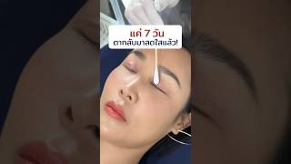 แค่ 7 วัน ตากลับมาสดใสแล้ว! #inzclinic #inZeye #ศัลยกรรมตา #จักษุแพทย์ #ทำตาสองชั้น #ตาสองชั้น