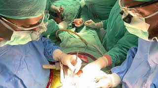 Bye pass graft open heart surgery Multan cardiology