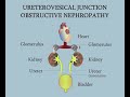 obstrucción de la unión ureterovesical