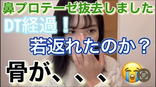 鼻プロテーゼ抜去しました！骨が、、、抜去体験談/DT経過/骨に関して気をつけた方が良いこと