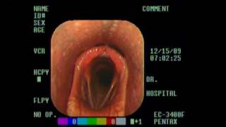 Normal Larynx .mpg