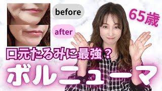 【ボルニューマ】口元たるみの施術を受けて当日・2週間後・1ヶ月後の経過と説明動画【たるみ】