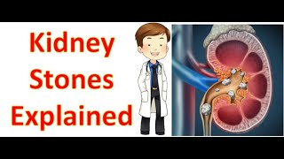 Kidney stones (nephrolithiasis) Explained- types and treatments