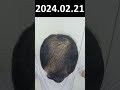 hair loss recovery without surgery. hair is growing back. ep.66 20240221