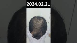 Hair loss recovery without surgery. Hair is growing back. ep.66 20240221