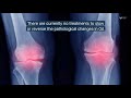 In osteoarthritis, pro-inflammatory proteins flip a metabolic switch in cartilage cells