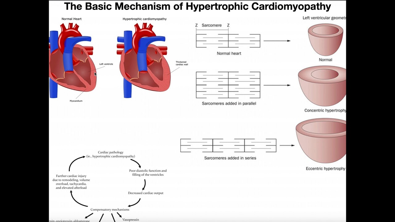 Hypertrophic Cardiomyopathy How The Heart Enlarges Pathologically