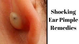 How to get rid of ear pimples 2x Faster