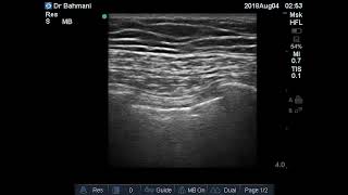 Case 229 : Normal Lung Sliding