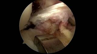 Arthroscopic Lateral Meniscus Root Repair