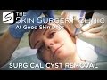 Cyst Removal | Watch the Procedure