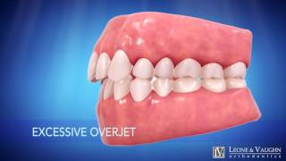 Smile Enhancement With Invisalign @ Leone \u0026 Vaughn Orthodontics!