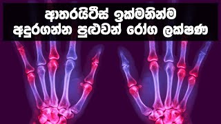 ආතරයිටීස් ඉක්මනින්ම අදුරගන්න පුළුවන් රෝග ලක්ෂණ