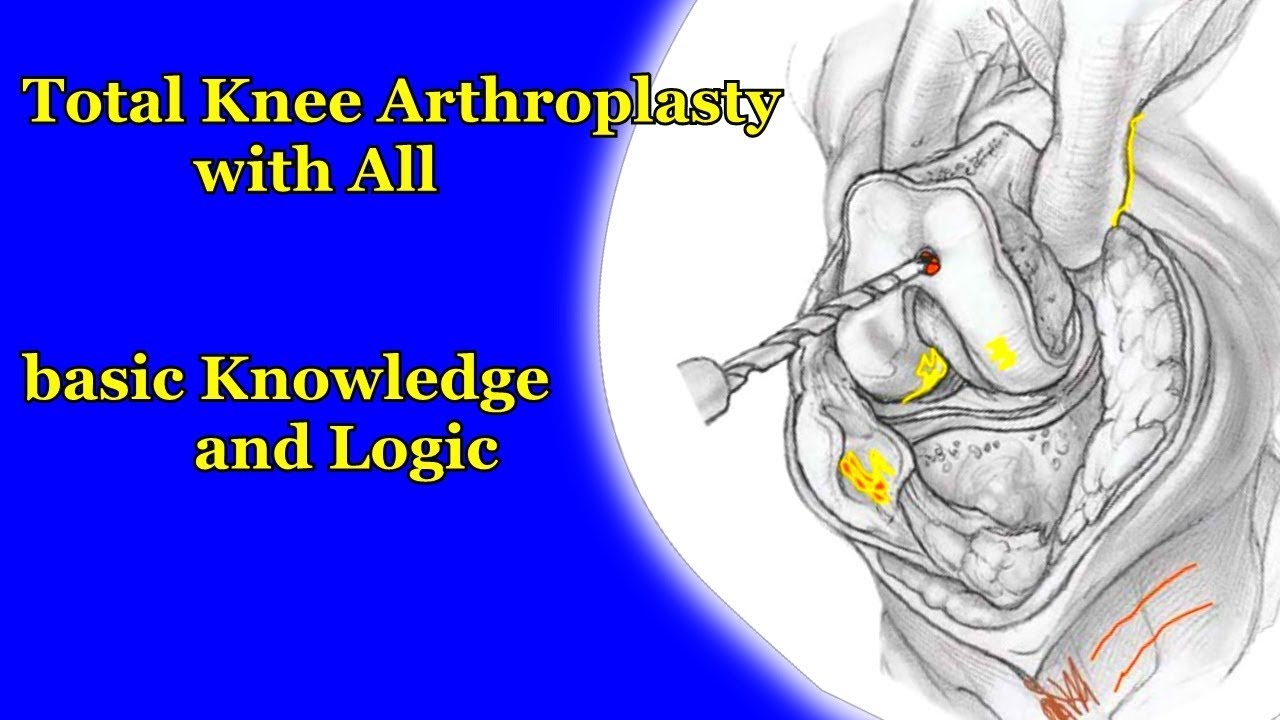 Total Knee Arthroplasty With All Basic Knowledge And Logic. ( Part 1 ...