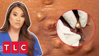 Woman Has Over 500 “PEBBLE” Bumps All Over Her Body | Dr Pimple Popper: This Is Zit