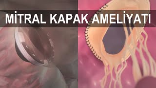 KALP KAPAĞI AMELİYATI | Mitral Kapak Ameliyatı