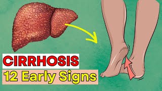 DON'T IGNORE! 12 Early Signs of Liver CIRRHOSIS | Daily Joy