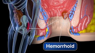 Hemorrhoid Removal | Step by step