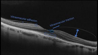 Course in clinical applications of OCT for macular diseases -Vitreomacular abnormalities part one