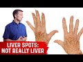 What Causes Liver Spots (Age Spots)? – Dr. Berg on Vitamin C Deficiency