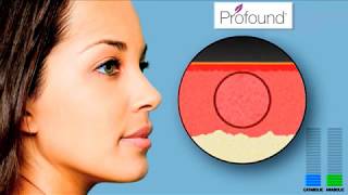 Profound RF Plus Non-Surgical Face Lift by St. Clair Cosmetic Clinic