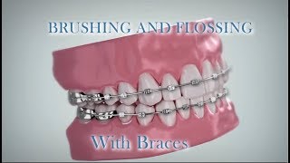 Brushing and Flossing With Braces English