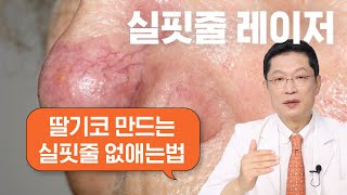 코 옆에 실핏줄을 혈관 레이저로 빨리 없애야 하는 이유