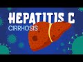 Hepatitis C & Cirrhosis // symptoms, diagnosis & treatment