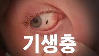 눈 벌레…?😱(feat.눈 기생충 제거)