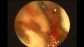 Unilateral Left sided Choanal Atresia  MEDtube