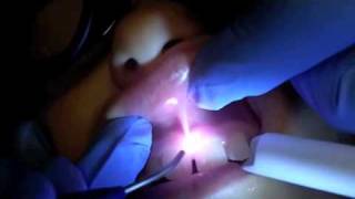 Maxillary Frenectomy