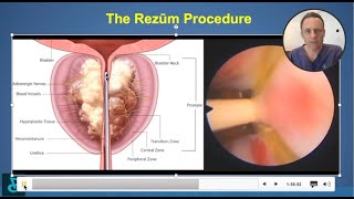 Before having a TURP find out what else is possible - The how to of Rezum