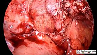 Laparoscopic Appendectomy for Acute Appendicitis in Pediatric Patient