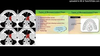 Double pedicled mucoperiosteal flaps for the prevention of restenosis in Draf IIb frontal sinusotomy