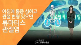 아침에 통증 심하고 관절 변형 있으면 류마티스 관절염 - (2010.10.28_349회 방송)_여성의 몸을 위협한다, 류마티스 관절염