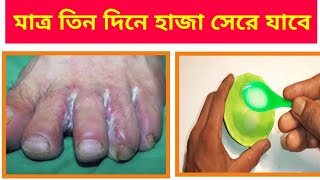 হাতে বা পায়ে হাজা ভালো হয়ে যাবে তিন দিনে,Home Remedies for Fungal Infection on Hand or Toe