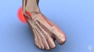 Mayo Clinic Minute: Ankle sprains 101