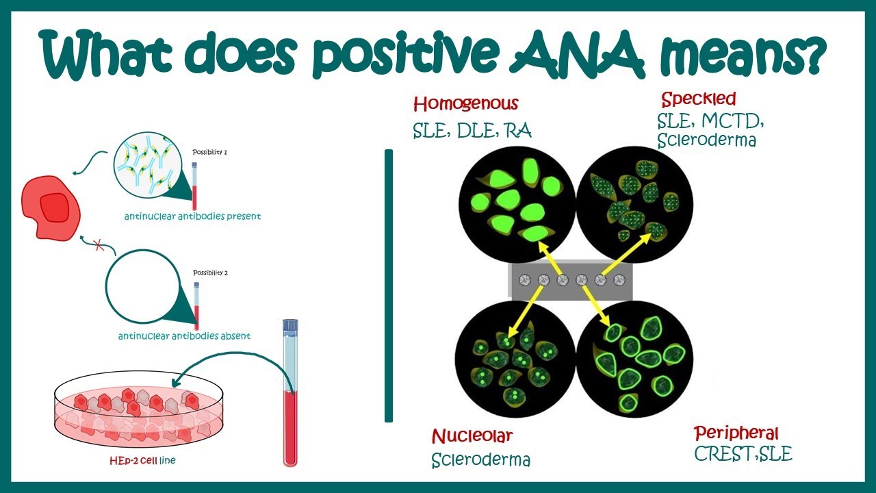 Antinuclear Antibodies (ANA) Test And Their Patterns | ANA Test | What ...