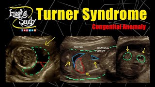 Turner Syndrome | 45,X | Monosomy X || Ultrasound || Anomaly || Case 276